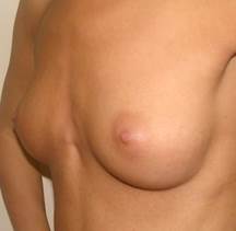 http://image.nauka.bg/bio/med/lozanov/Augmentation%20mammoplasty1.jpg